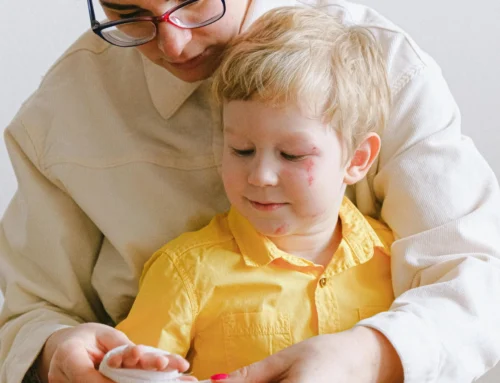 Burns and Scalds in Kids: First Aid, What to Watch For, and When to Get Help